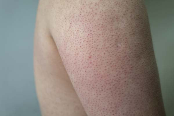 How to Treat Keratosis Pilaris