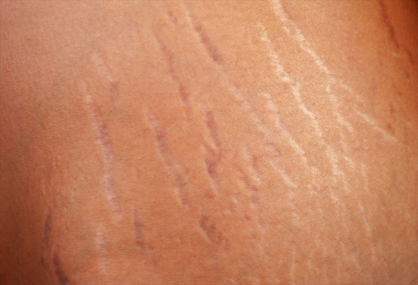 How to Treat Stretch Marks