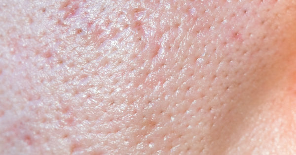 How to "Shrink" Pores