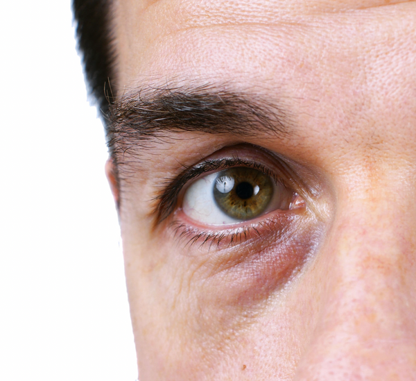 How to Treat Under Eye Bags