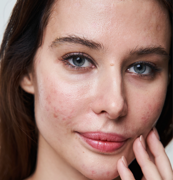 How do you treat adult acne?