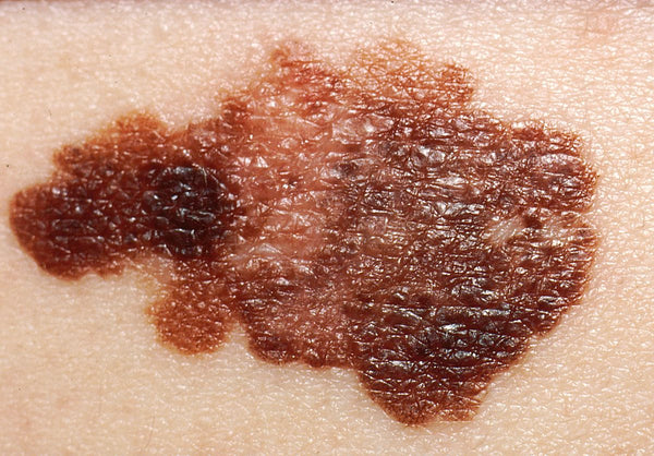 How to Identify Skin Cancer