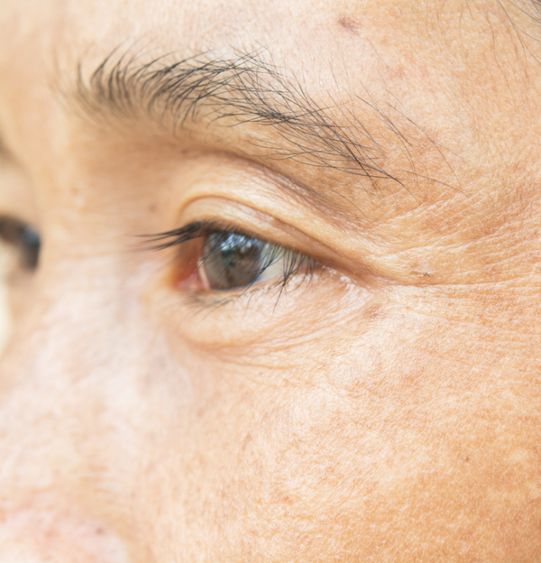 What is melasma and what causes it?