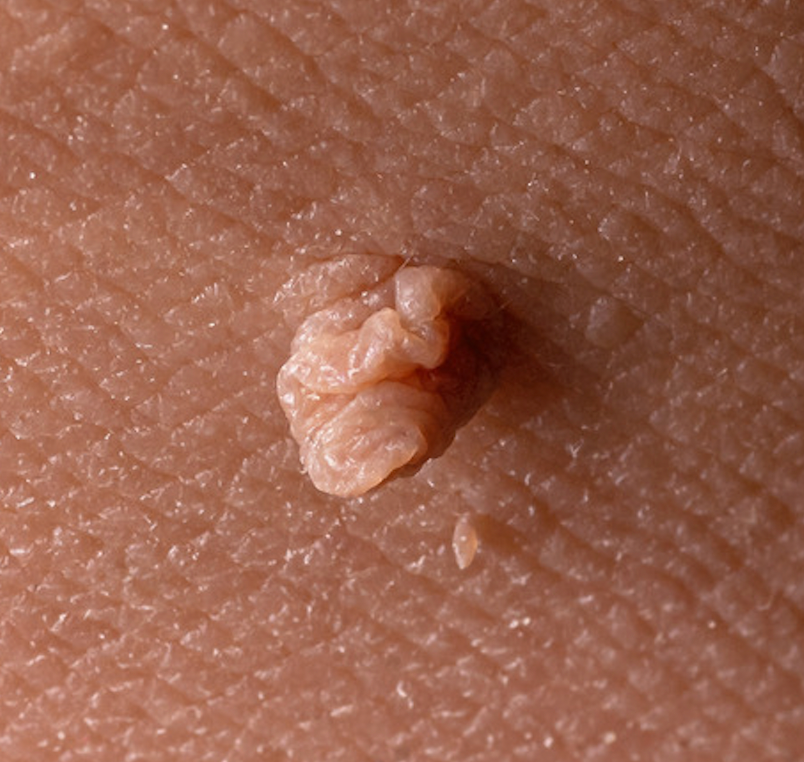 Skin Tag Like Rash How to Treat Skin Tags like a Dermatologist – Remedy Science by Dr ...