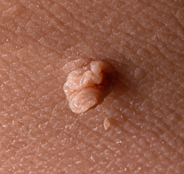 How to Treat Skin Tags like a Dermatologist