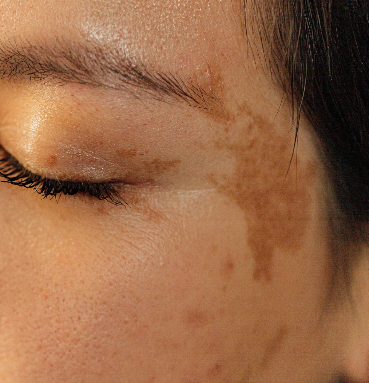 Hyperpigmentation Math Hyperpigmentation