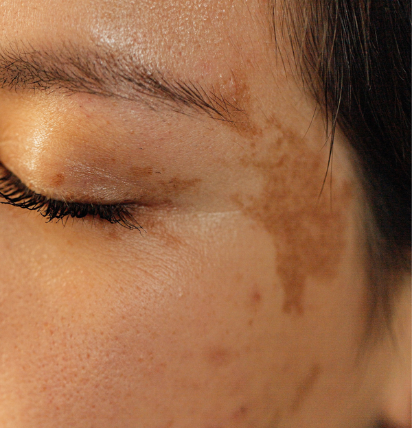 How to Treat Hyperpigmentation like a Dermatologist