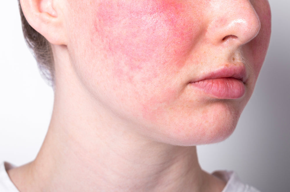 Understanding Rosacea