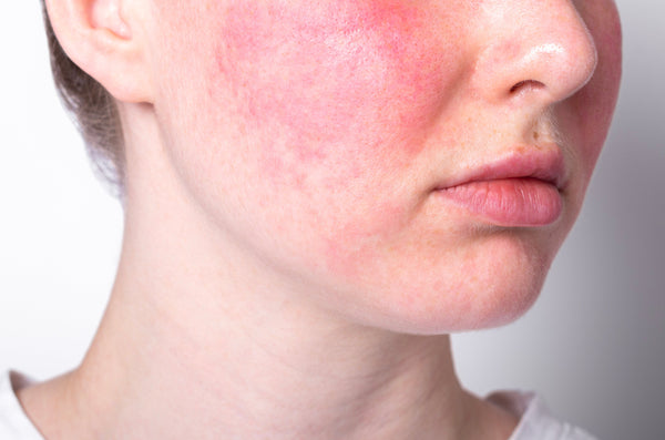 How to treat Rosacea