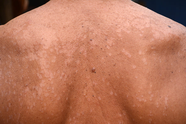 Tinea versicolor